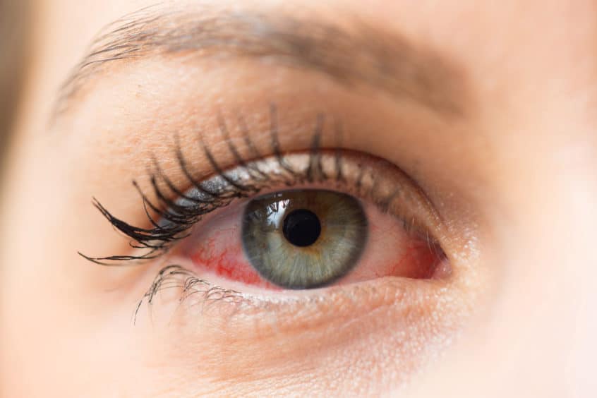 Why Are My Eyes Sore and Itchy? Everything You Need To Know About Dry