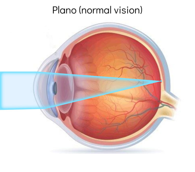myopia sightedness