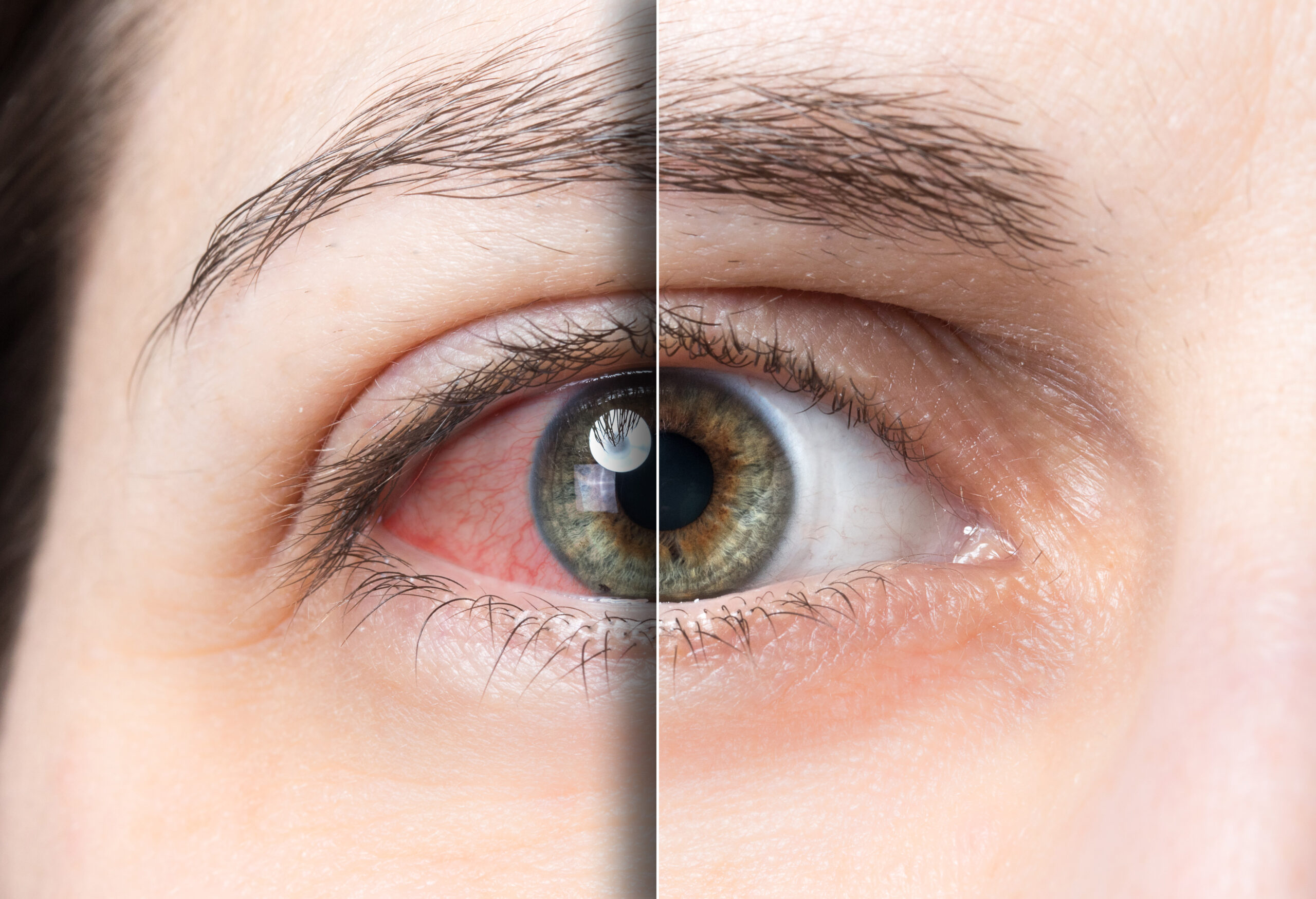 Featured image for “What is IPL? And how can it help dry eye?”
