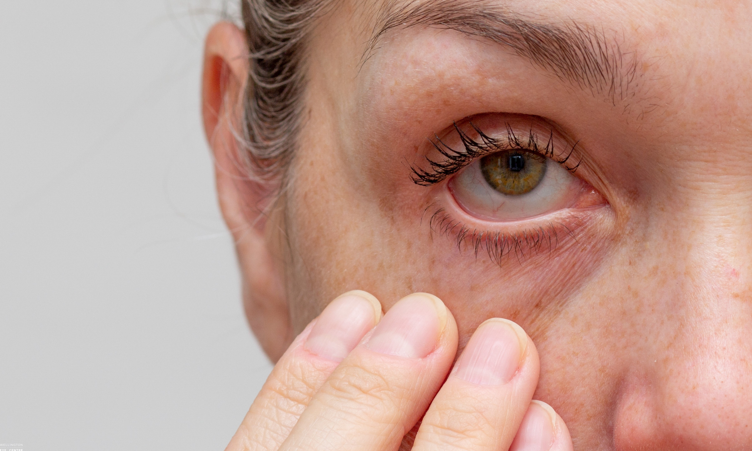 Featured image for “What is Blepharitis?”