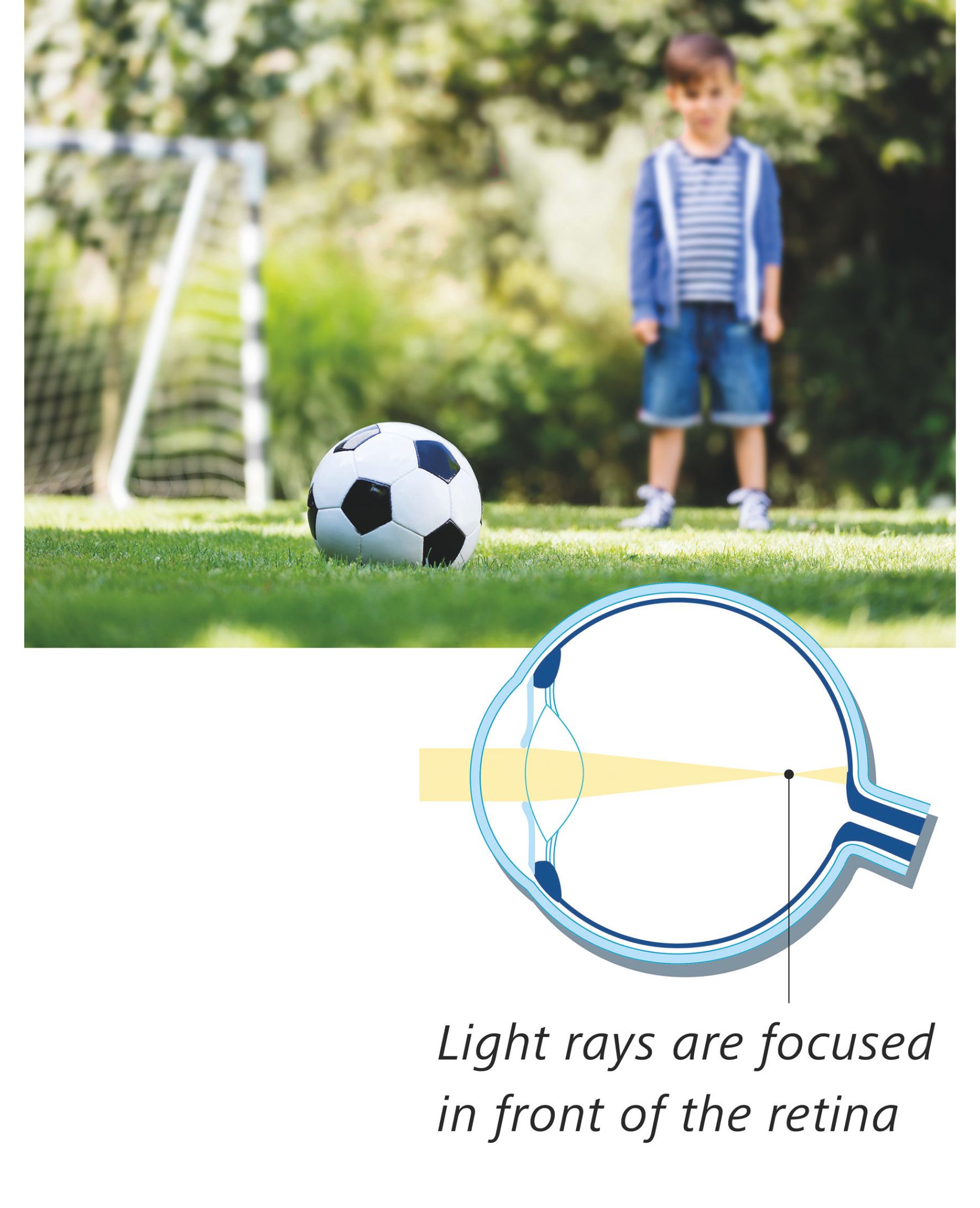 PRESBYOND Recovery: What to Expect After Laser Blended Vision Surgery ...